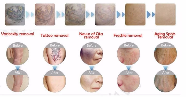 Wholesale Dealer Best Laser Tattoo Removal Picosure 755 Picosecond Laser