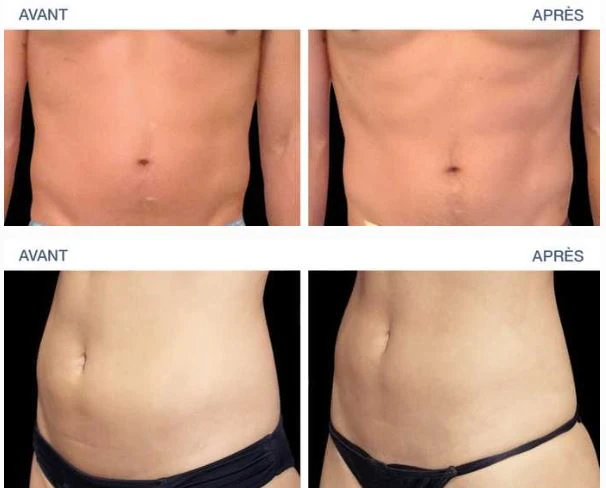 EMSCULPT Machine